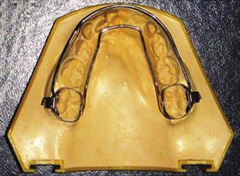8 Many intraoral appliances have been used to correct maxillary deficiency as alternative procedure to the FM therapy due to its poor esthetics.