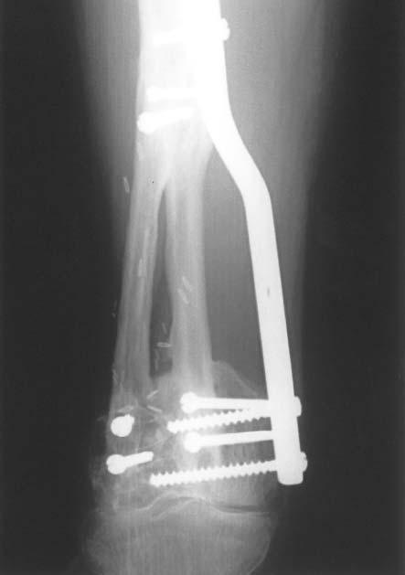 Muramatsu et al: Femur Reconstruction by Vascularized Fibula Graft Figure 1. Radiograph of Case 1 at 3 years. A 37-year-old woman with a giant cell tumor of the distal femur.