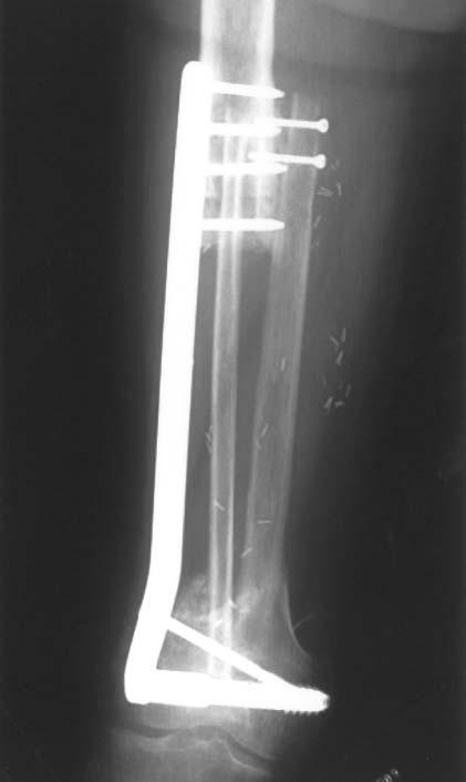 Bony union was achieved within 7 months post-operatively. Full weight bearing was permitted 10 months and no stress fractures occurred thereafter.