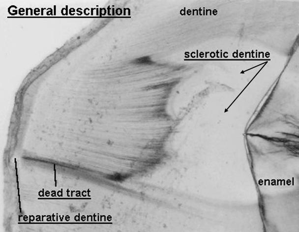 Types of Dentin: Sclerotic Sclerosis of dentin is the naturally occurring deposition of minerals within tubules that results in a thicker layer of peritubular dentin.
