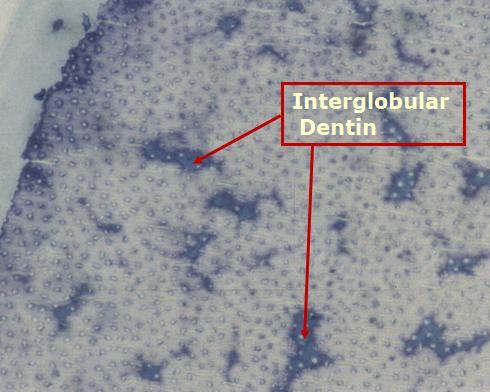 Types of Dentin: Globular vs. Interglobular Dentin Arrows indicate regions of hypocalcified dentin called interglobular dentin.