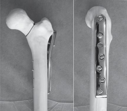 a trend toward lower failure of fixation with a fixed angle device (DHS cephalomedullary rod or DCS), compared with cannulated screws. Aminian et al.