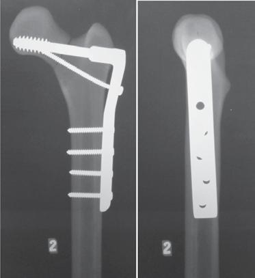 The study showed a superior strength of the proximal femoral locking plate (PFLP) compared with DHS, DCS, and 7.3mm cannulated screws.