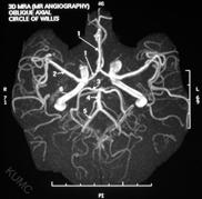 Internal carotid artery Diffusion Tensor Imaging