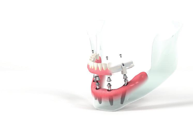 Straumann Pro Arch is a comprehensive solution that includes a broad range of implants, abutments, CAD / CAM frameworks, bars, bridges and other components that enable clinicians and dental