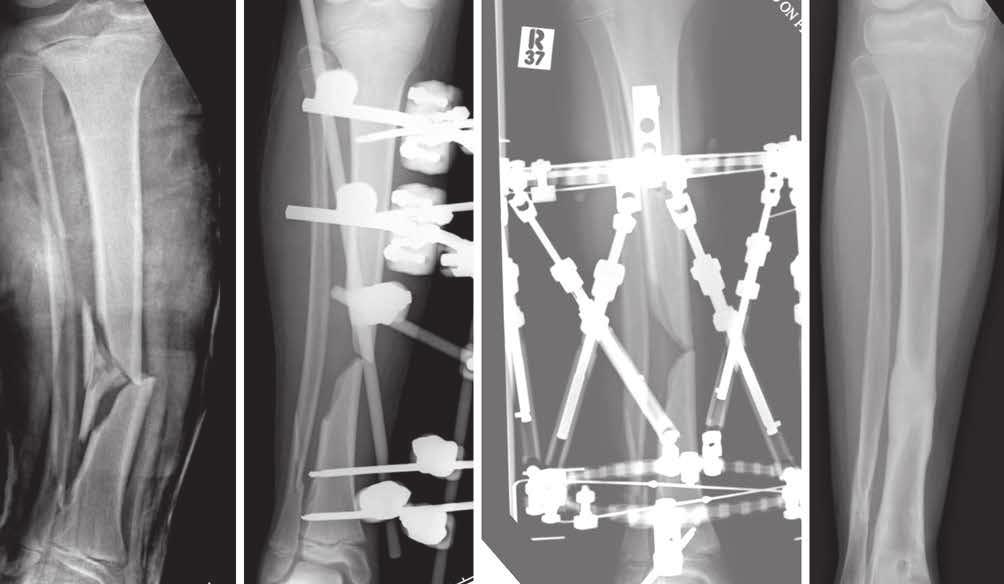 366 j. a. humphrey, s. gillani, m. j. barry Fig. 1. Plain AP radiograph of an 11 year old boy with an isolated grade IIIB open right tibial fracture, following pedestrian versus car trauma.