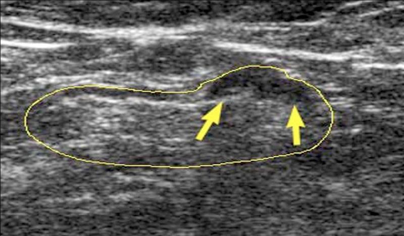 Nodal Ultrasound at Diagnosis Whole breast and draining