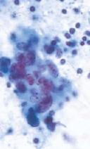 Ultrasound Guided FNA