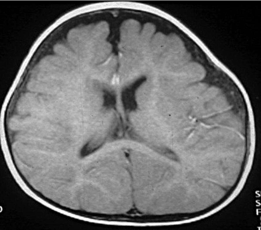 FIG 2. Benign external hydrocephalus in a 7-month-old infant with mild ventriculomegaly and increased CSF in the frontal subarachnoid space.