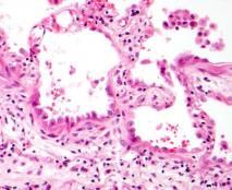 interstitial chronic inflammation Granulomas: inconspicuous or absent