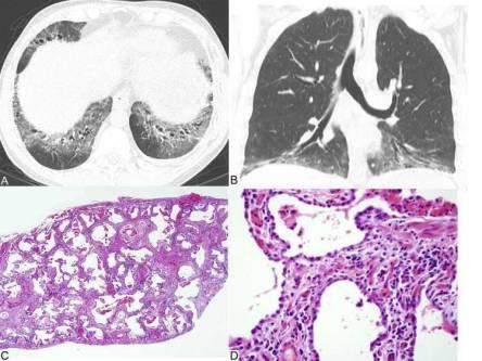 21/07/2017 ATS/ERS/JRS/ALAT Statement: Idiopathic Pulmonary Fibrosis: Evidencebased Guidelines for Diagnosis and Management. Conclusion: Histologic pattern of in non-ipf patients. Raghu G et al.