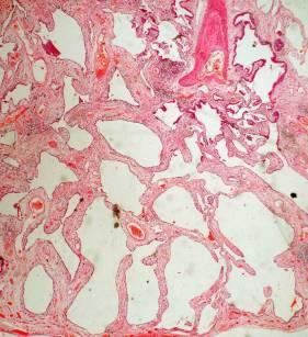 Histopathology: F-NSIP MDT review: HRCT favours chr HP History of bird exposure Levels cut on block FINAL DIAGNOSIS: CHR HP Update on NSIP SOME PATIENTS WITH IDIOPATHIC NSIP SUBSEQUENTLY DEVELOP
