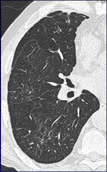 NSIP LAM HP Idiopathic pulmonary