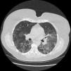 Sarcoidosis Vasc Diffuse Lung Dis. 2016;33:2-9. In 75% of cases, SLBx deemed unnecessary after Cry-bx. In 12/13 subjects, an SLB was performed confirming Cryo-TBB results in 92%.