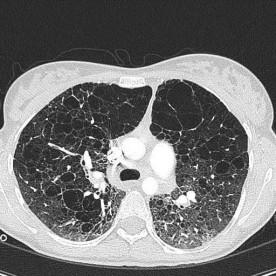 [Epub ahead of print] Raparia K et al. Transbronchial Lung Cryobiopsy for Interstitial Lung Disease Diagnosis: A Perspective From Members of the Pulmonary Pathology Society Arch Pathol Lab Med.