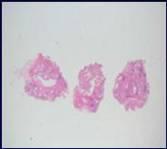 Fibrolastosis Rare histologic patterns Acute fibrinous and