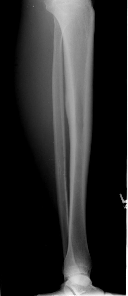 Companion Patient #1: Radiograph of L tibial osteoid osteoma 21 yr old male with 4 months of atraumatic left calf pain, worse at night; osteoid osteoma