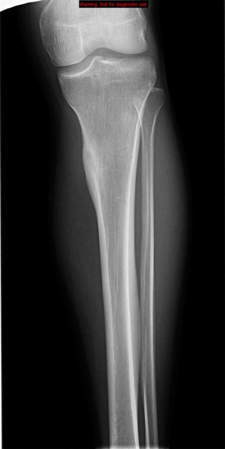 Companion Patient #2: Radiograph of L tibial osteoid osteoma 18 yr old male with nocturnal focal pain in L proximal tibia for 2 years; relief with NSAIDs; osteoid