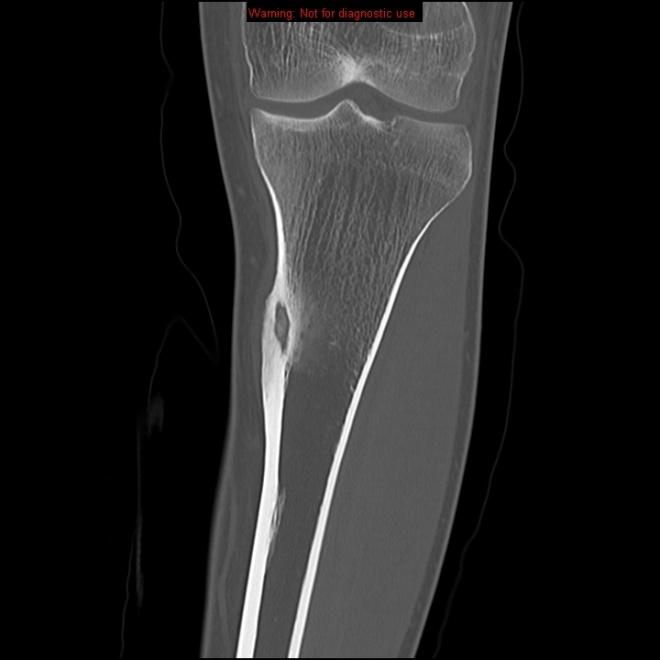 Companion Patient #2: L tibial osteoid osteoma on Coronal CT Coronal C- CT Oval-shaped