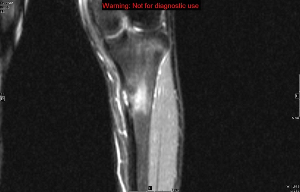 Companion Patient #2: L tibial osteoid osteoma on MRI STIR Coronal C- MRI STIR