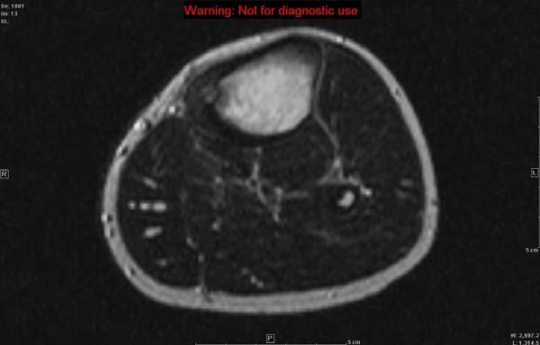 Companion Patient #2: L tibial osteoid osteoma on MRI