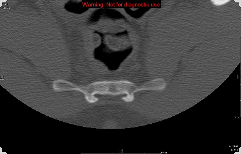 Companion Patient #3: Sacrococcygeal osteoid osteoma on CT Imaging 19 yr old male with 1 yr hx of pain at coccyx, worse at night pain & relieved with ibuprofen; osteoid