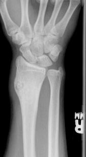 Our Patient: Radiograph of cortical osteoid osteoma in R distal radius AP Radiograph Ovoid