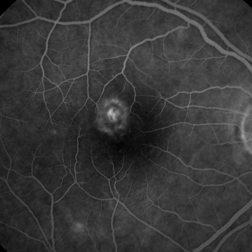 What is Fundus Fluorescein Angiography and Indocyanine Green