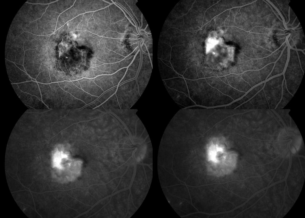 Introduction Fundus Fluorescein Angiography (FFA) is a routine retinal examination of the tiny blood vessels of the retina at the back of your eye.