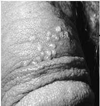 cervicitis; ~15-30%recurrent McGraw-Hill, Sexually Transmitted Disease,
