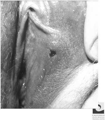 circumcised, no discharge, urethral meatus very tender to palpation 2 mm circular