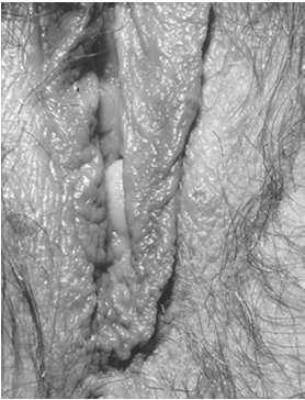 swelling or testicular mass/pain Skin: no rash HSV as a Cause of Urethritis Genital