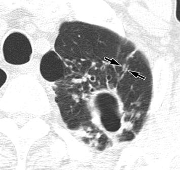 On review of the thin-section chest CT scans, 24 of the 50 patients showed cavitary nodules or cavitary consolidations in the lung (male female ratio, 13:11; mean age, 61 years; age range, 43 82