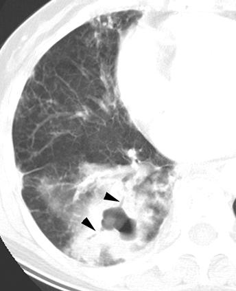 CT of Nontuberculous Mycobacterial Pulmonary Infection TABLE 1 Thin-Section CT Findings of 24 Cases of the Cavitary Form of Mycobacterium avium-intracellulare Complex No.