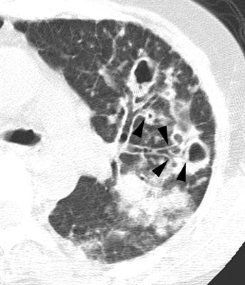 Fig. 3. 66-year-old woman with Mycobacterium aviumintracellulare complex pulmonary infection with multiple feeding bronchi. Transaxial thin-section CT scan (2.