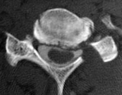 Approach: Instability n Panjabi and colleagues n functional spine unit remains stable if: n All anterior