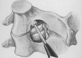 Posterior ligamentous elements are intact n Despite extensive facetectomy n Zdeblick and colleagues n In