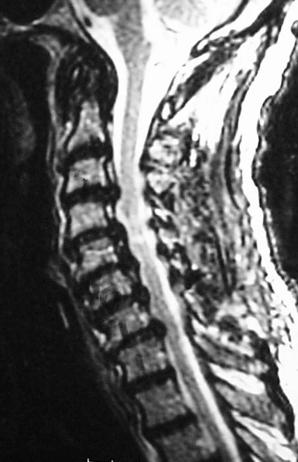 Laminoplasty - Controversies n Increased axial pain /
