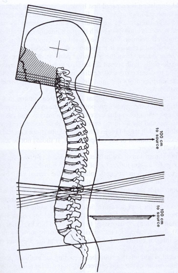 Craniospinal (CSI) fields were used to prevent the development of spinal metastases.