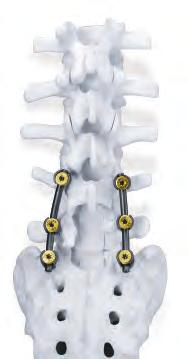 Introduction During the past decade there has been a continuous evolution in the design for pedicle screw fixation systems.