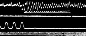 23 SENAC: Cinchona bark for palpitations (1749) FREY: On atrial fibrillation in humans and Its Elimination by Quinidine (1918) Ventricular