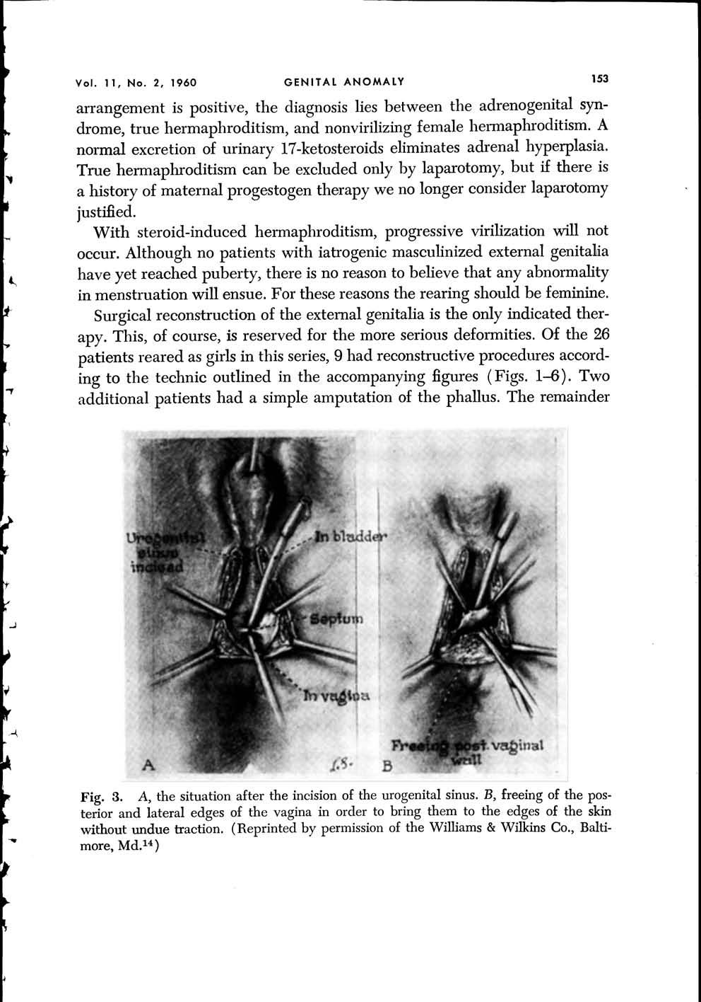 Vol. 11, No. 2, 1960 GENITAL ANOMALY 153 arrangement is positive, the diagnosis lies between the adrenogenital syndrome, true hermaphroditism, and nonvirilizing female hermaphroditism.