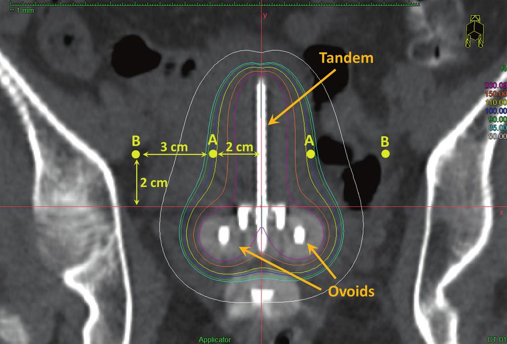 2. General Physics Principles in Brachytherapy 29 if the tandem is favoring one side of the pelvis due to anatomy Bladder point - the most dependent portion of the foley balloon with 7 cc of contrast