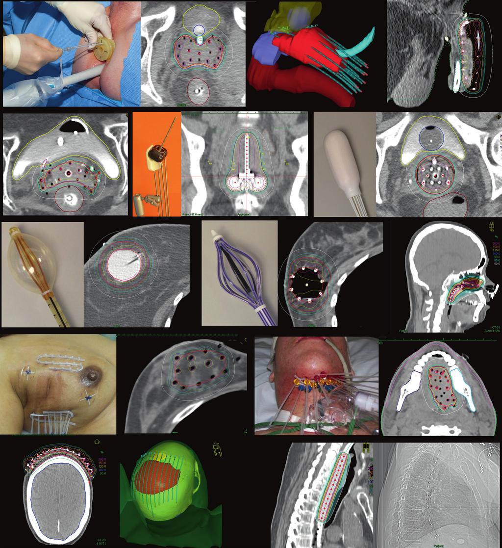 2. General Physics Principles in Brachytherapy 21 Fig. 2.1. Types of brachytherapy implant.