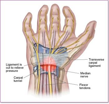 What is carpal tunnel syndrome? Carpal tunnel syndrome is a common condition characterised by decreased sensation and pain in the palm of the hand, index fingers, middle fingers and thumb.