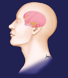 am Surgical Treatment of Migraine Headaches 11:40 am Panel Discussion Panelists: David Branch, MD; ; Jeffrey Janis, MD; David Stepnick, MD 12:30 pm Live botulinum toxin A injection for Treatment of