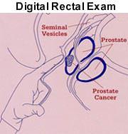 The Digital Rectal Exam (DRE) Only 1/3 of gland is examined nodularity/induration/ asymmetry suspect 60% of cancers detected