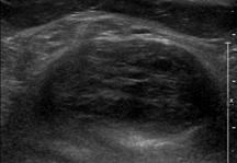 Bumps: Ultrasound