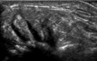 nerve Proximal ulnar