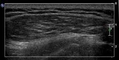 flow <5 cm Anterior knee